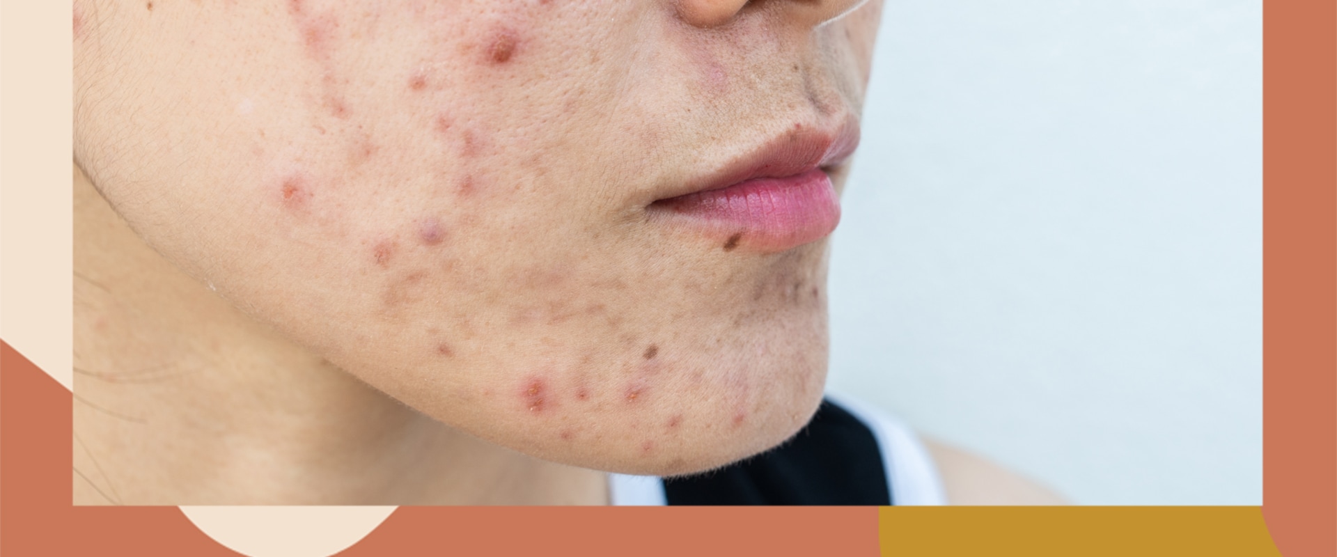 can-skin-care-products-cause-cystic-acne