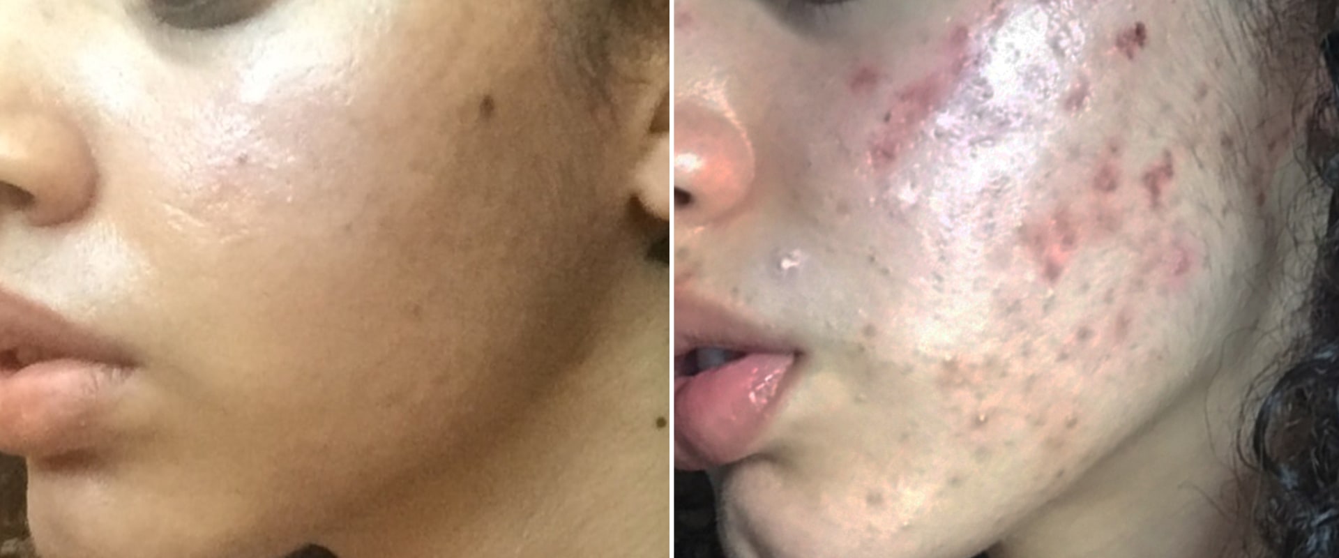 can-skin-care-products-cause-acne